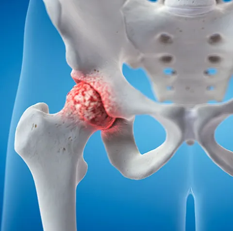Hip Replacement for Arthritis: Why Robotic Surgery...