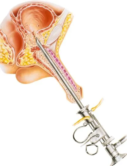 TURP treatment in Thane Transurethral Resection of...