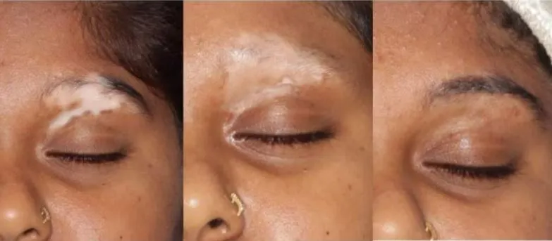 Effective PRP Therapy for Vitiligo Treatment at Gi...
