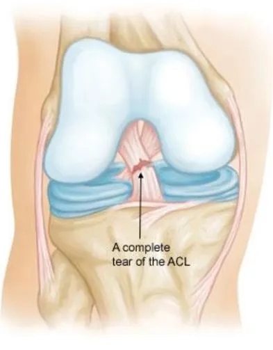 Understanding Ligament Tears and Their Treatment O...