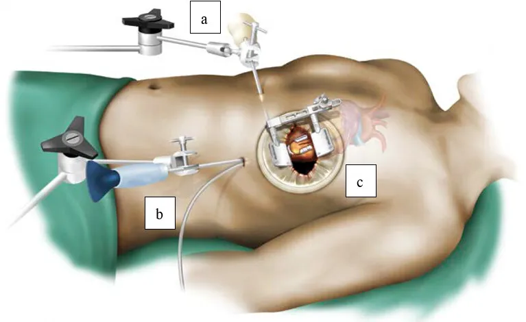 MICS CABG Surgery Specialist in Nagpur Minimally i...