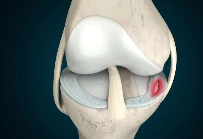 Medial Meniscus Tear Treatment in Nashik A medial ...