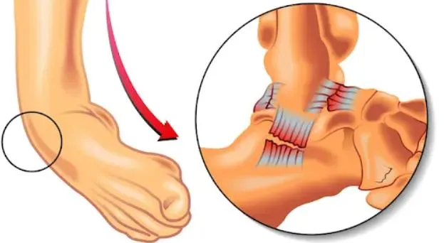 Ligament Injuries Treatment in Nashik Ligament inj...
