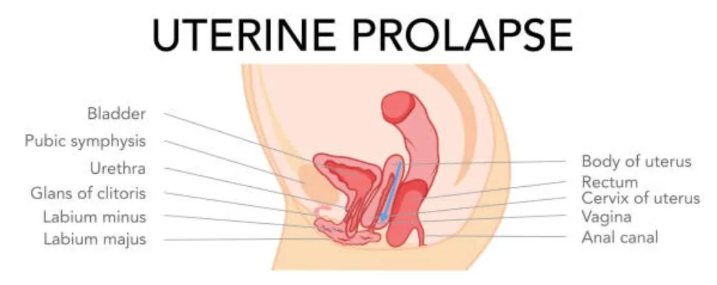 Effective Treatment for Uterine Prolapse in Thane ...