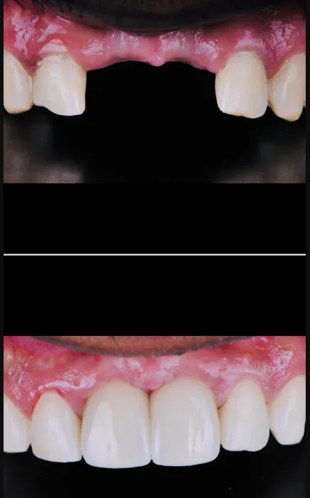 Best Dental Implant clinic in Chennai Looking for ...