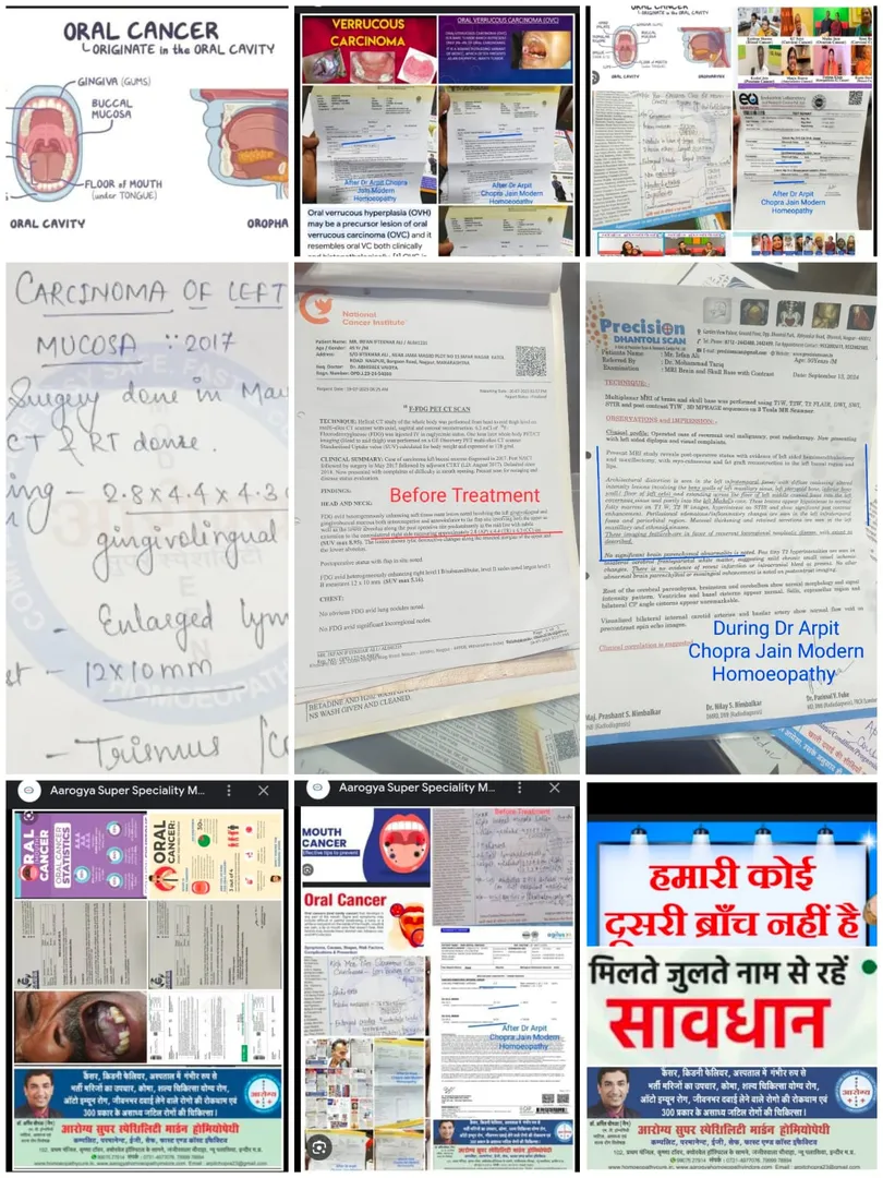 Oral Cancer Mouth Buccal Mucosa Post Operated Recu...