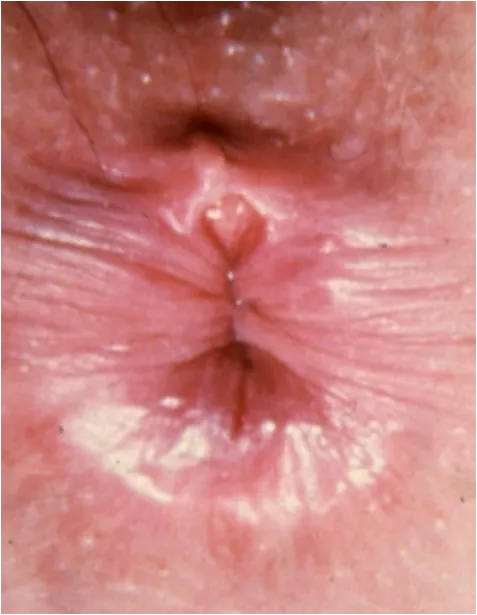 Understanding How Anal Fissures Happen An anal fis...