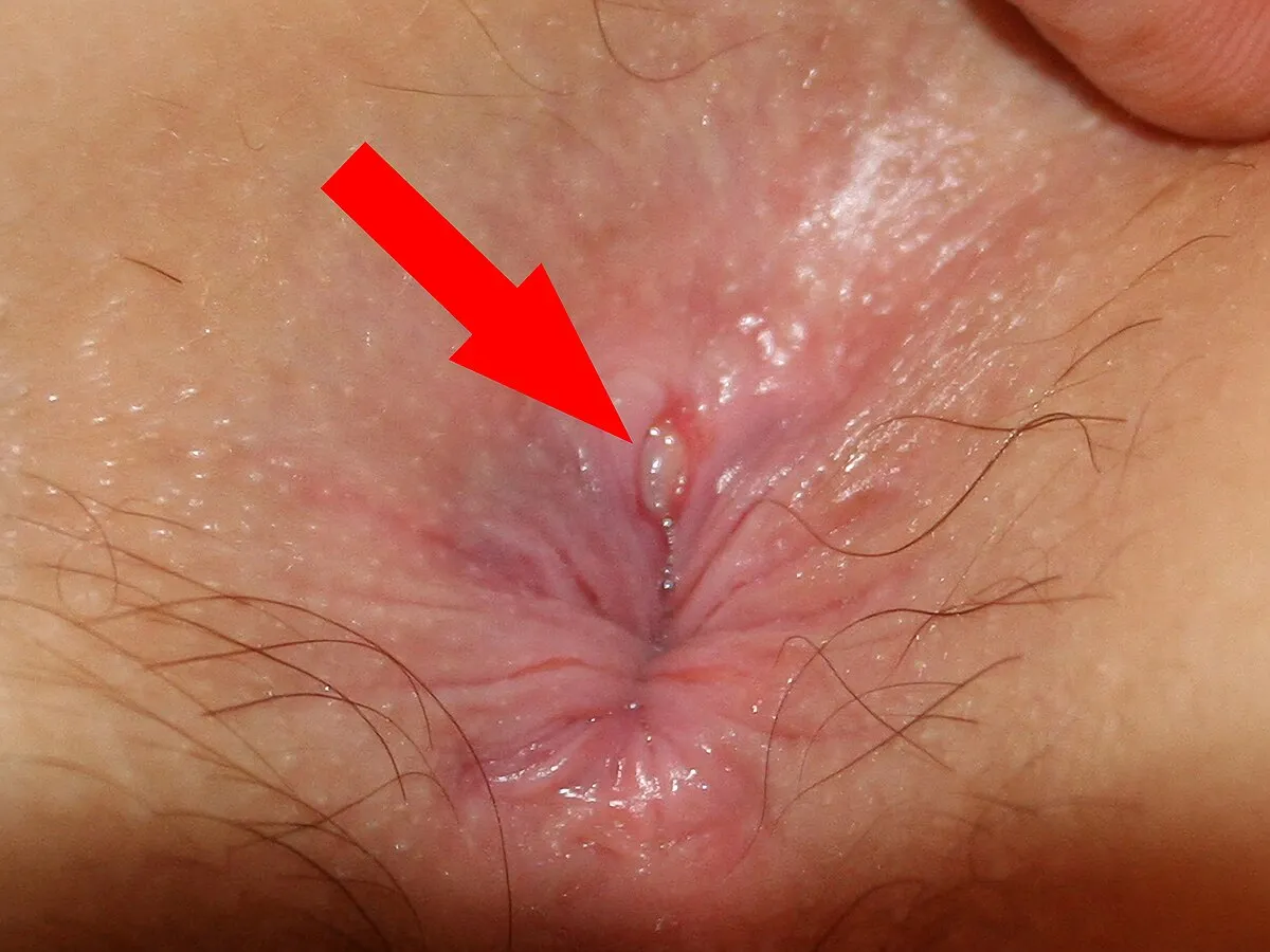 Treatment Options for Anal Fissures Anal fissures,...