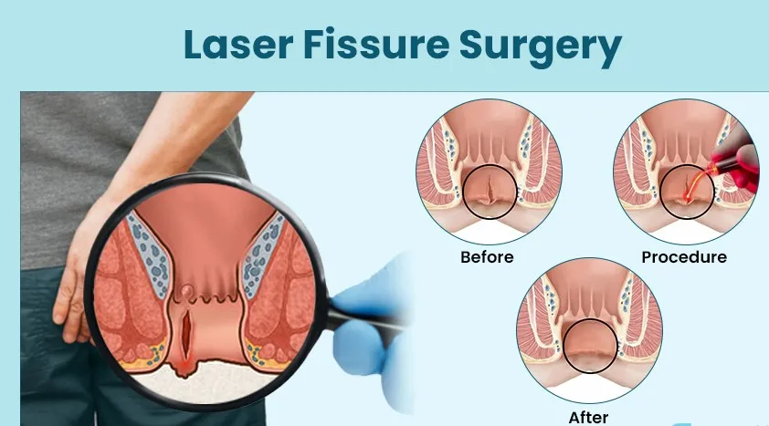 Laser Treatment for Anal Fissures: A Modern Approa...