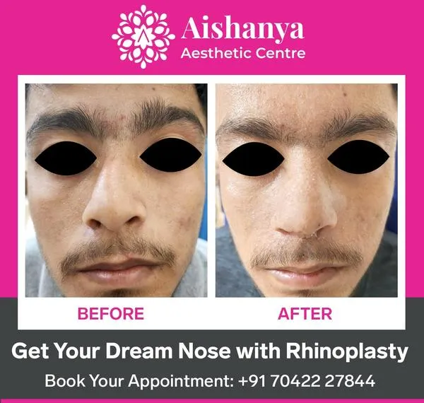 Nose Job in Delhi – Achieve the Perfect Nose with ...