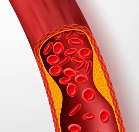 Identifying and Treating Blockages in the Heart Bl...