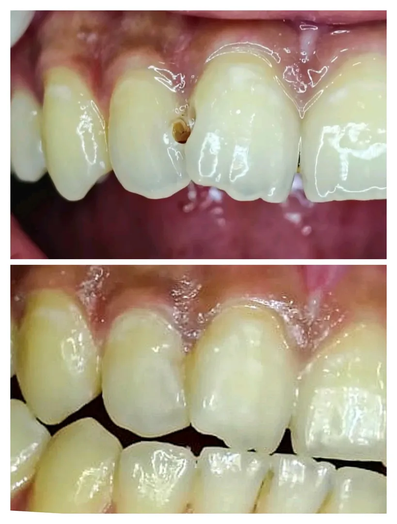 Bonding and Tooth coloured Fillings can restore yo...