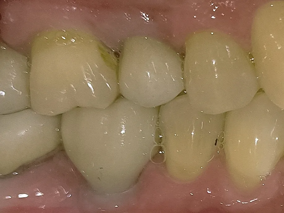 Teeth on Dental Implants feel and look just as nat...