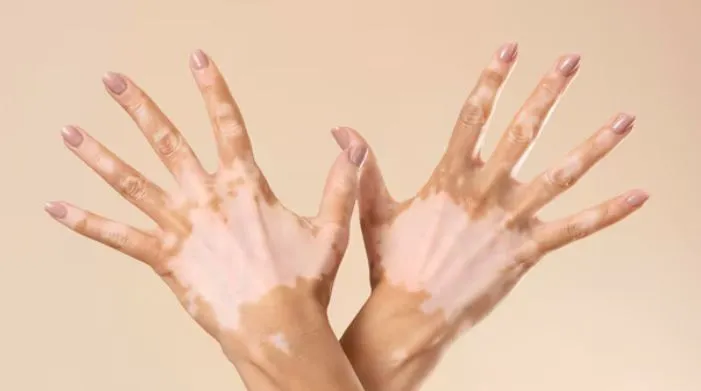 Vitiligo Treatment in Dhule Vitiligo is a skin con...