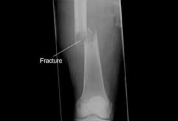 Long Bone Fracture Treatment in Nashik Long bone f...