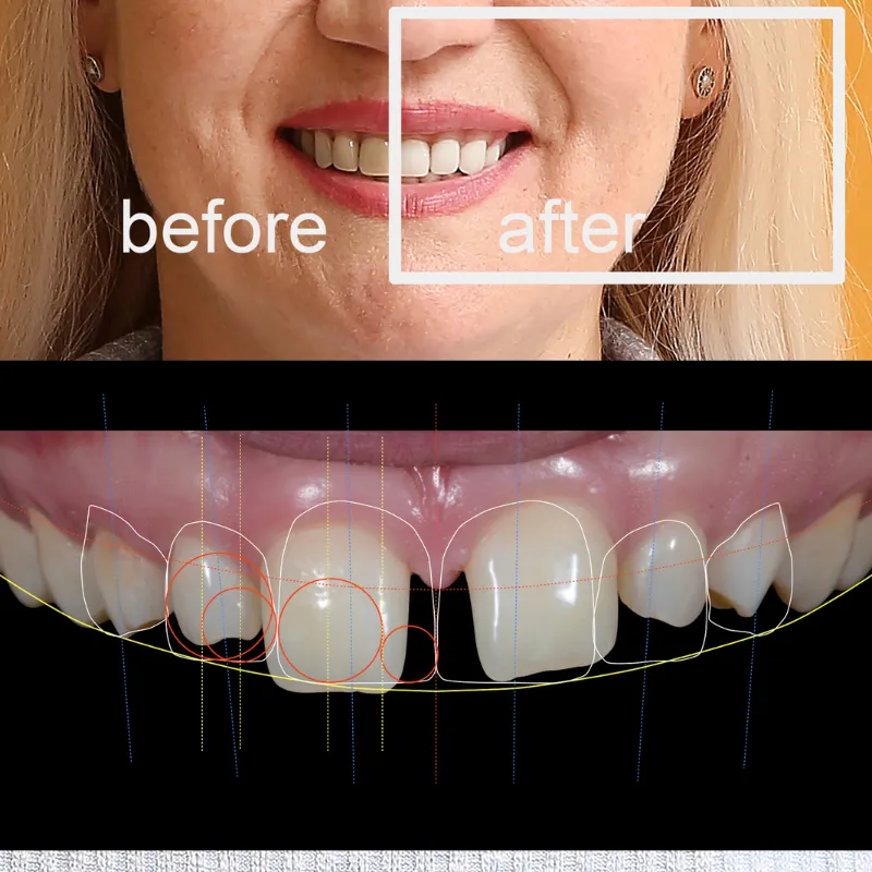 Digital Smile Design
Best way to assess, plan and ...