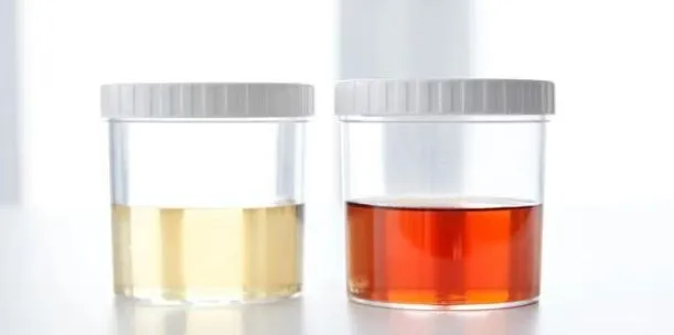 Blood in Urine (Hematuria): Causes and Treatment i...