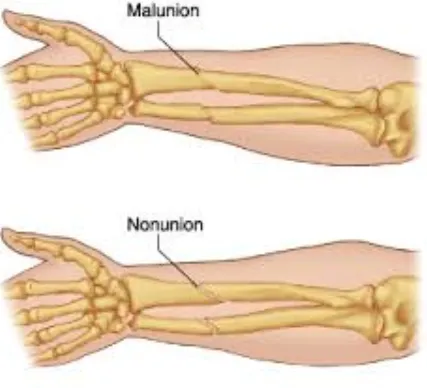 Nonunion and Malunion Treatment at Anand Orthopaed...