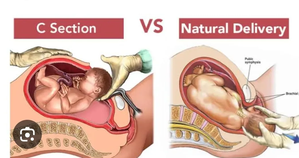 The chances of having a cesarean delivery versus a...