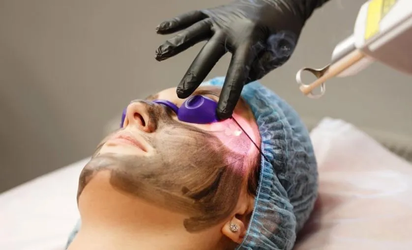 Carbon Laser Treatment in Nashik At Niti Skin and ...
