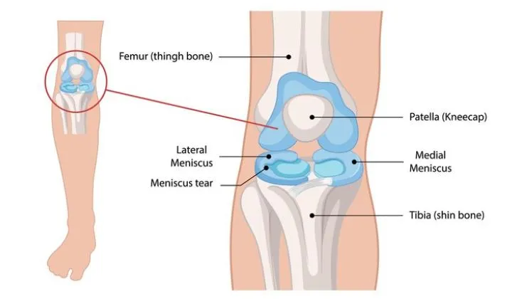 Lateral Meniscus Tear Treatment in Nashik A latera...