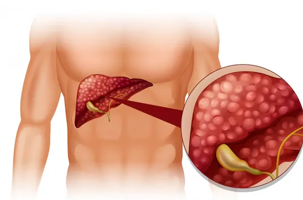 Best Gallstone Removal Doctor in Kalyan West Galls...
