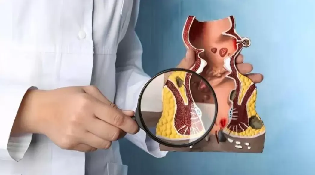 Recurrence of Fistula in Ano After Surgery: Causes...