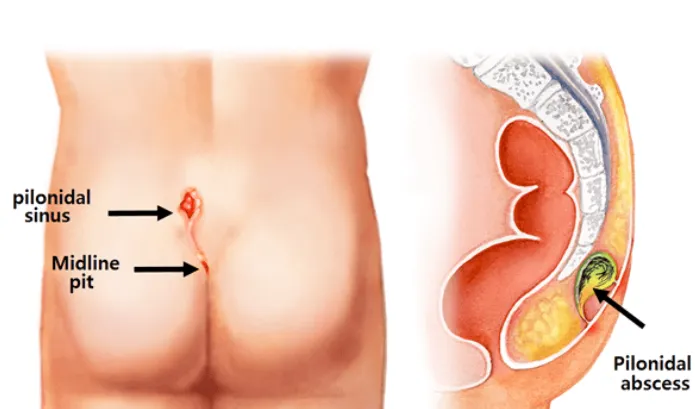 Best Pilonidal Sinus Doctor in Kalyan East Pilonid...