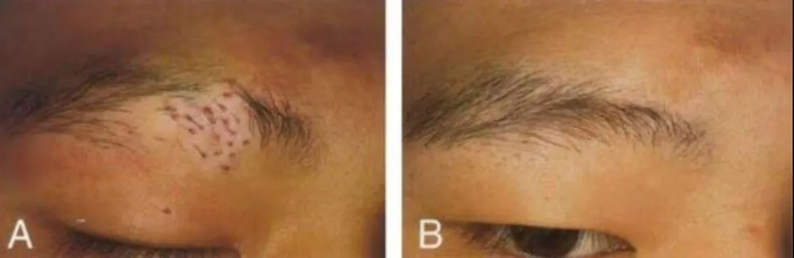 Hair Transplant for Vitiligo in Dhule For those wi...