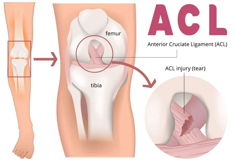 Ligament Injuries Treatment in Nashik Ligament inj...