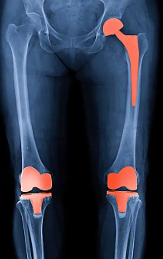 Specialized Knee and Hip Replacement in Pimpri-Chi...