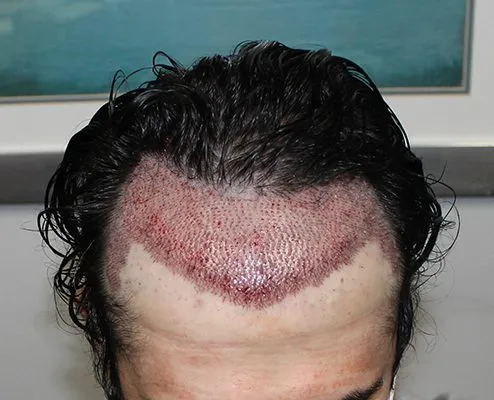 How to Sleep After an FUE Hair Transplant Did you ...