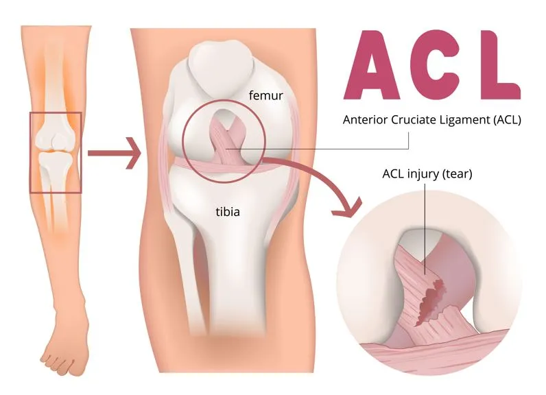 ACL Tear Recovery Treatment in Nashik An ACL tear ...