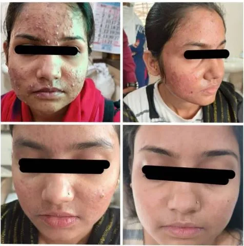 Chemical Peeling for Acne in Dhule: Clear Your Ski...