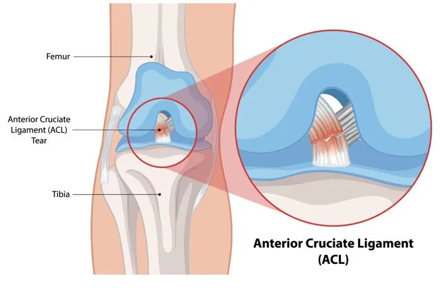 Recovering from Ligament Tears treatment in Nashik...