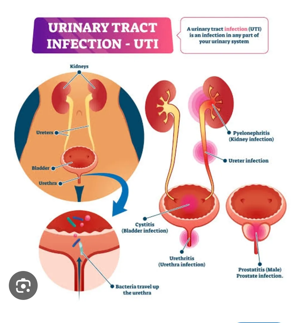 Urinary tract infections (UTIs) during pregnancy c...