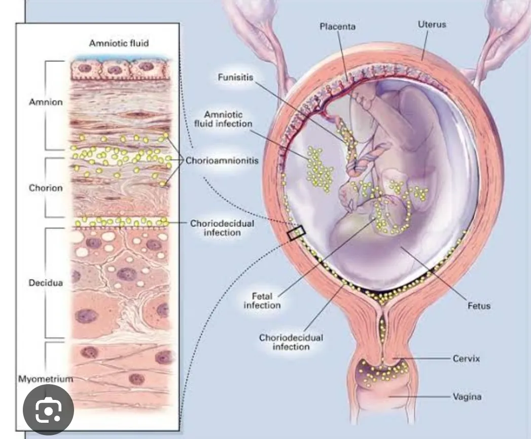 Vaginal infections during pregnancy can also incre...