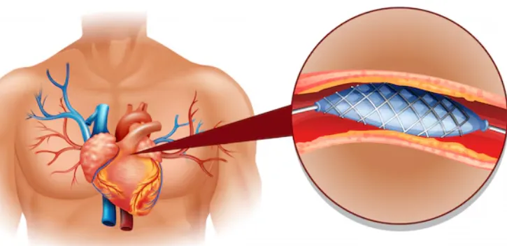 Blocked Arteries and Their Connection to Heart Att...