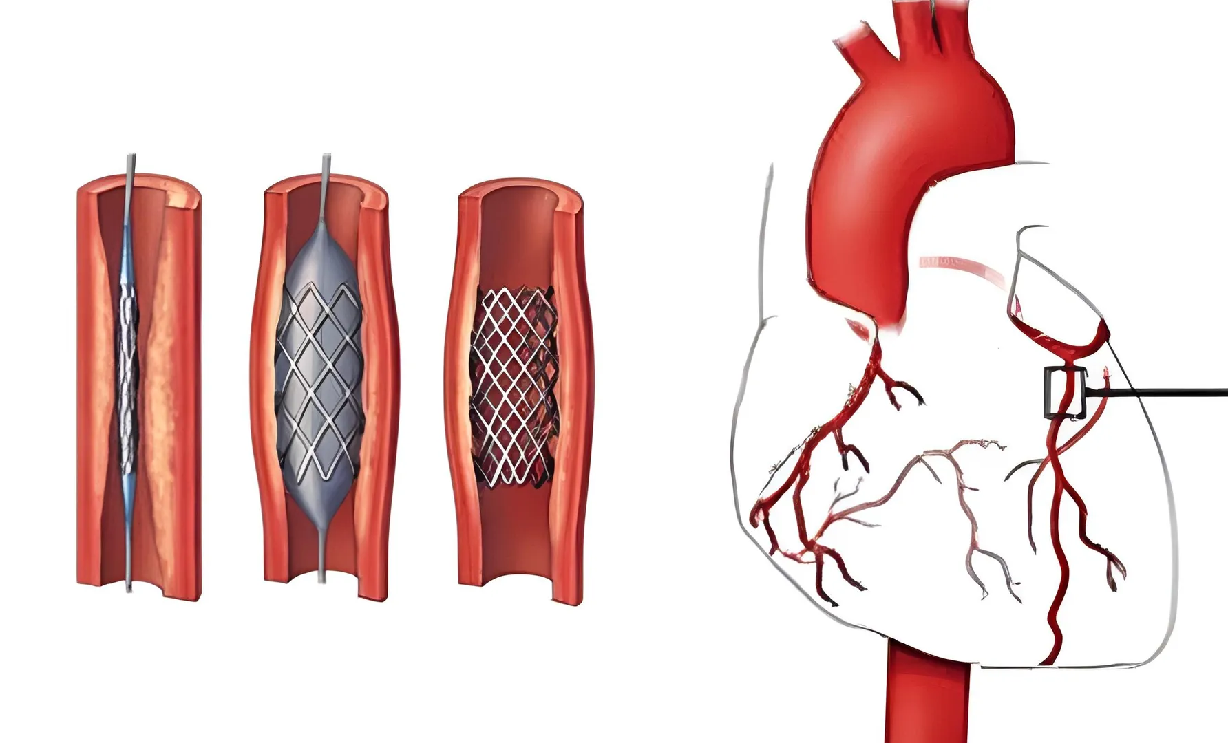 Completion Angiography: Assessing Heart Health Pos...