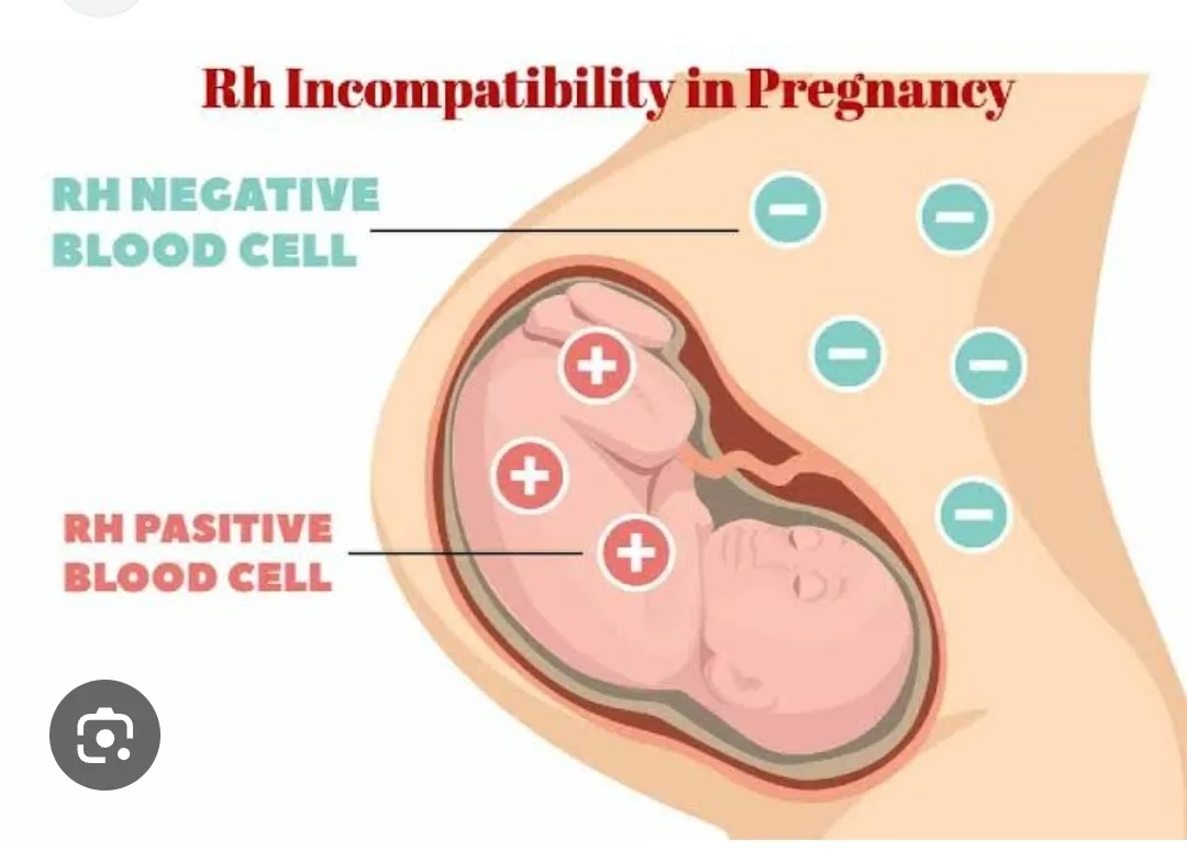 Rh-negative blood type can be important in pregnan...