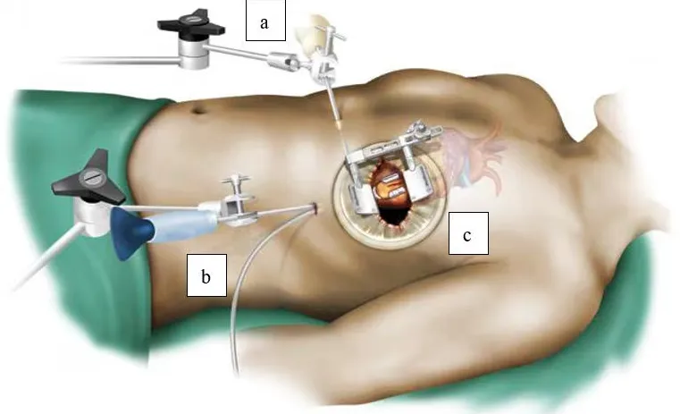 MICS CABG: Minimally Invasive Cardiac Surgery for ...