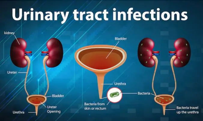 Urinary Infection Treatment in Thane Dr. Vivek Jad...