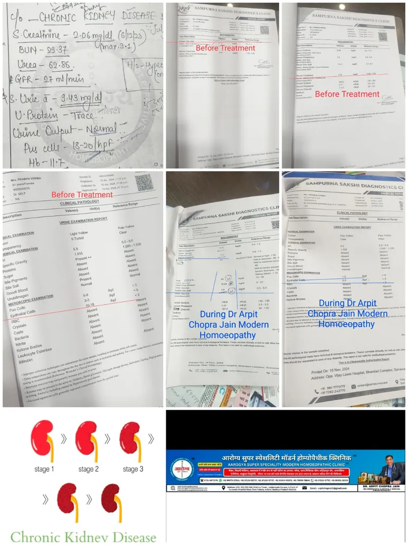 Chronic Kidney Disease with High Creatinine 2.25 t...