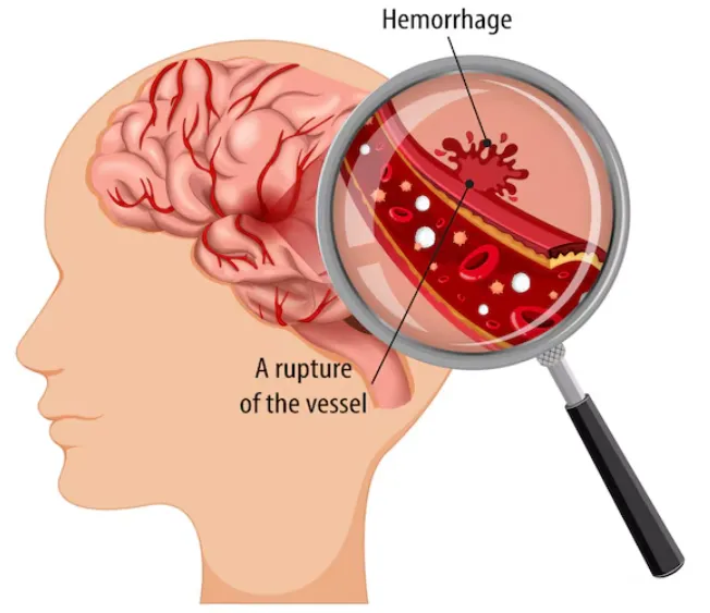 Head Injury and Brain Hemorrhage Treatment: Compre...