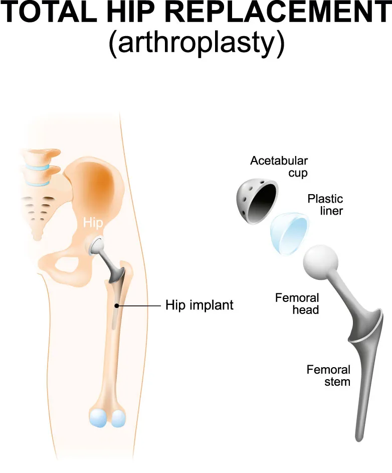 Total Hip Replacements in Khadakpada Kalyan West :...