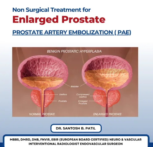 PROSTATE ARTERY EMBOLIZATION ( PAE) has been a gam...