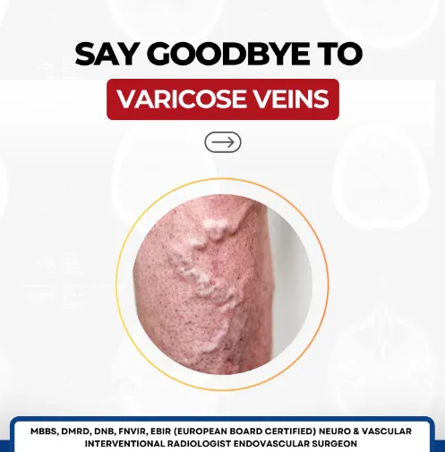 Ignoring varicose veins can lead to more serious h...