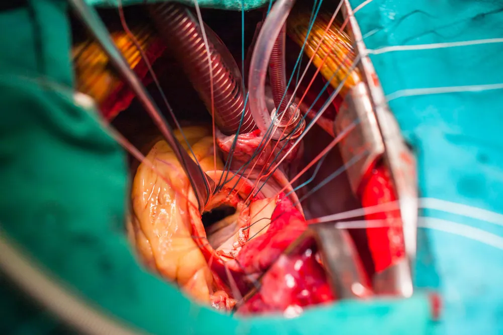 Valve Surgery in Nagpur: Restoring Heart Function ...