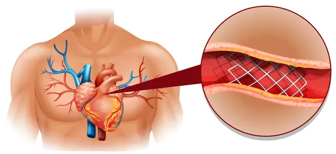 Affordable Cardiologist for Blocked Arteries in Ch...