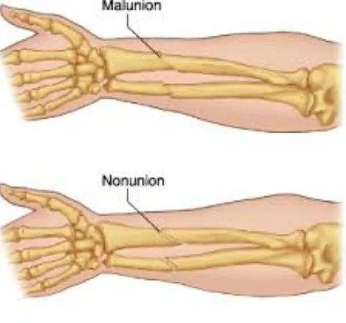 Professional Nonunion and Malunion Treatment in Pi...